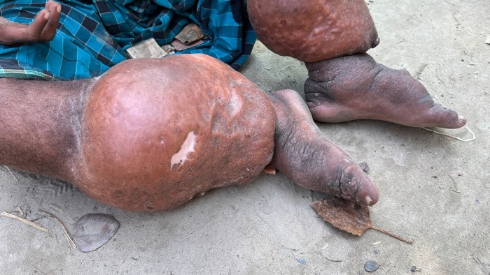 Inchaço nos membros inferiores, sintoma da filariose, doença causada por vermes.