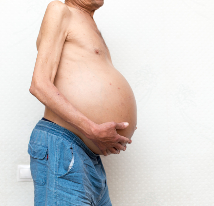 Homem com acúmulo de líquido no ventre, sintoma da esquistossomose, doença causada por vermes.