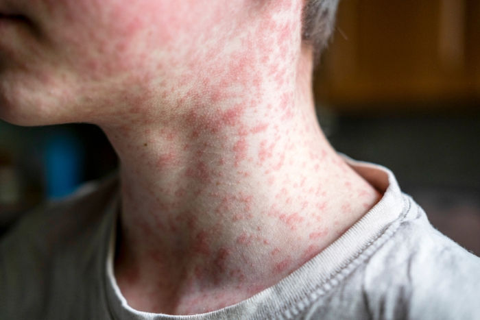 Criança apresentando sintomas de sarampo, com manchas vermelhas espalhadas pelo corpo.