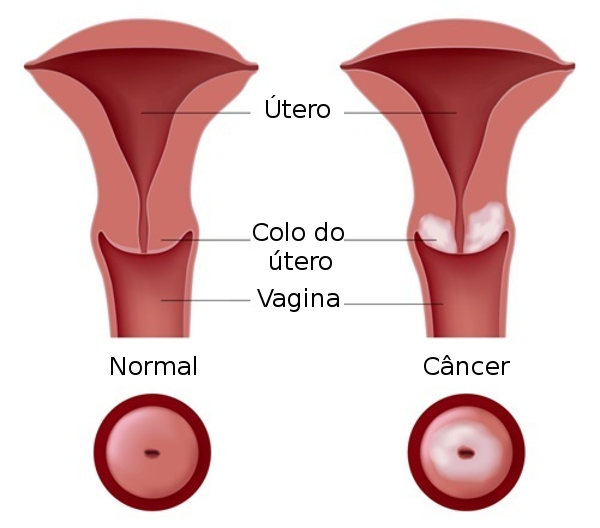 O câncer do colo do útero em seu estágio inicial não causa sintomas.