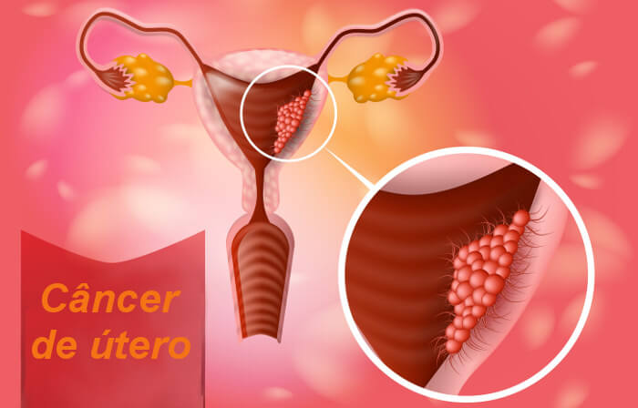 O câncer de útero pode afetar as diferentes pares do corpo do útero.
