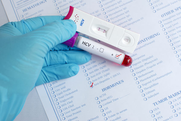 O diagnóstico de hepatite C é feito por meio de exames.