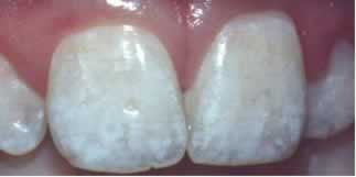 Fluorose dental