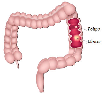 Alguns pólipos estão relacionados com o câncer colorretal