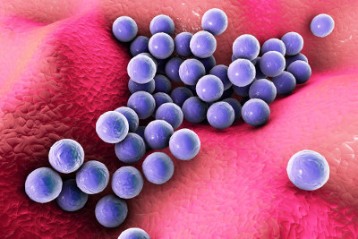 O furúnculo é geralmente causado por bactérias do gênero Staphylococcus