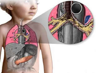 Fibrose Cística: evidenciando o acúmulo de secreção no sistema respiratório.