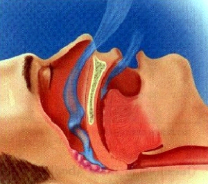 A Apnéia do Sono consiste no bloqueio do fluxo de ar durante o sono.