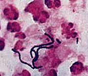 Streptococcus: bactéria responsável pela febre reumática