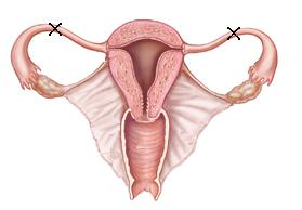 A laqueadura impede que o óvulo se aloje no útero e encontre com o espermatozóide