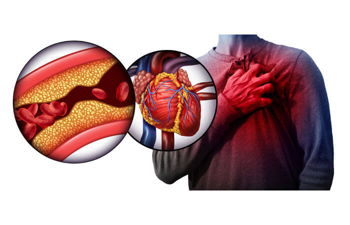 Quais os sintomas do infarto e os fatores de risco para a doença?