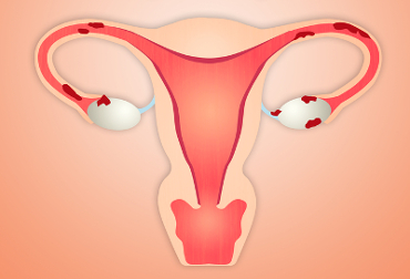 O câncer de ovário geralmente afeta as mulheres acima de 40 anos de idade