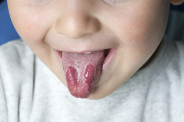 Observe as manchas vermelhas que surgem na língua do paciente