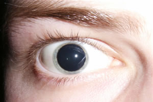 Pupila dilatada, um dos efeito do LSD.