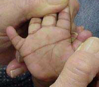 Mão de uma criança com Síndrome de Down.
