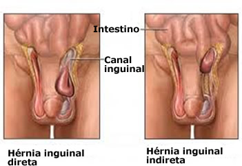 HÉRNIA INGUINAL: ENTENDA O QUE É A HÉRNIA INGUINAL