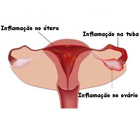 A doença inflamatória pélvica atinge os órgãos genitais internos