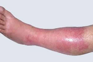 artrite bacteriana febre