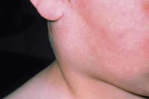 A caxumba é uma infecção viral que apresenta inflamação das glândulas salivares