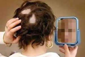 A alopecia caracteriza-se pela perda repentina de pelos, formando círculos na região acometida.