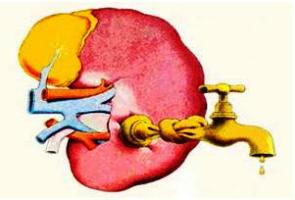 Pacientes com insuficiência renal aguda têm o volume de urina reduzido 
