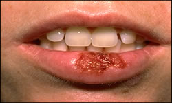 Herpes Simples