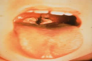 Indivíduo acometido pela difteria. Observe a membrana localizada em sua garganta. 