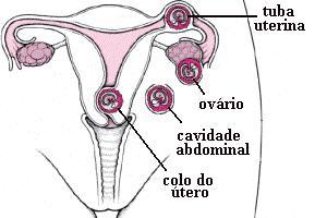 A gravidez ectópica ocorre mais frequentemente na tuba uterina.