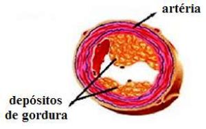 o aumento da placa de gordura pode interromper o fluxo sanguíneo, causando infarto do miocárdio ou derrame