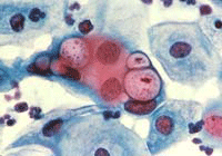 Bactéria Chlamydia