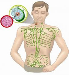 O linfoma atinge os nódulos linfáticos localizados no pescoço, axilas e virilha.