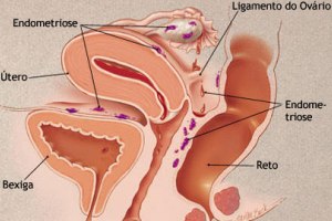 Algumas das principais localizações da endometriose.