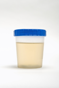 O diabetes insipidus caracteriza-se pela produção abundante de urina clara e não concentrada