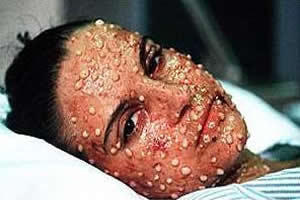 As lesões da varíola, na maioria das vezes, deixam cicatrizes. 