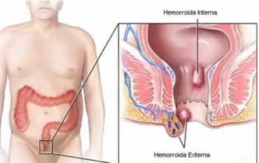Qual a diferença entre hemorroida e cancer anal