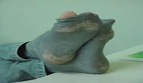 A utilização de meias sujas e estragadas pode originar o chulé.